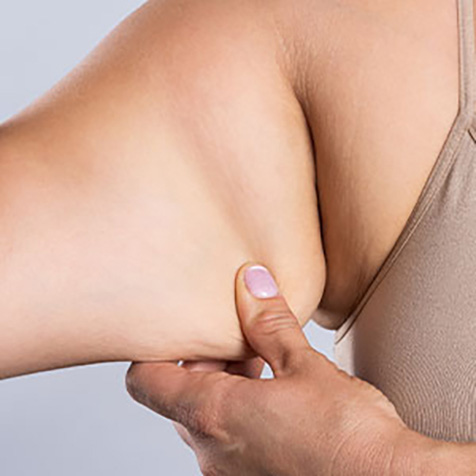 Bat Wings treatment options at True Form Medical Group in Fremont