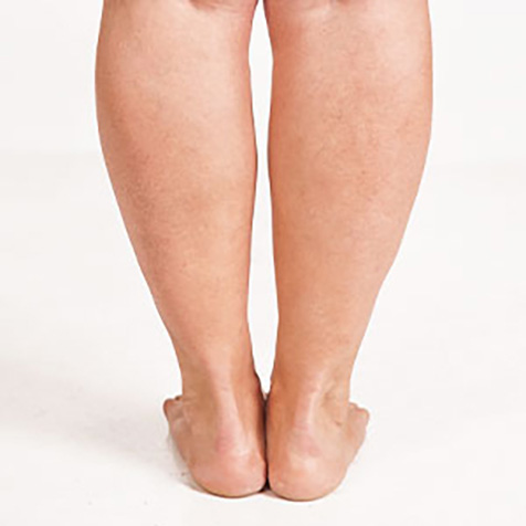 Cankles treatment options at True Form Medical Group in Fremont