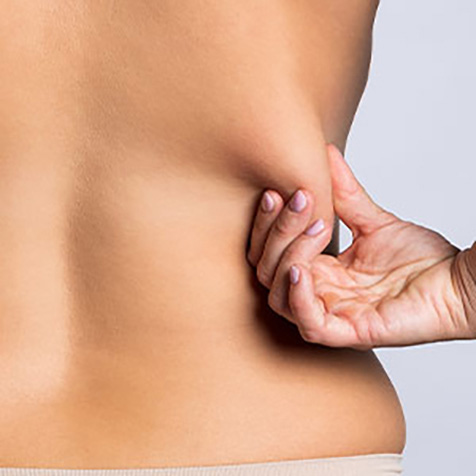 Love Handles treatment options at True Form Medical Group in Fremont