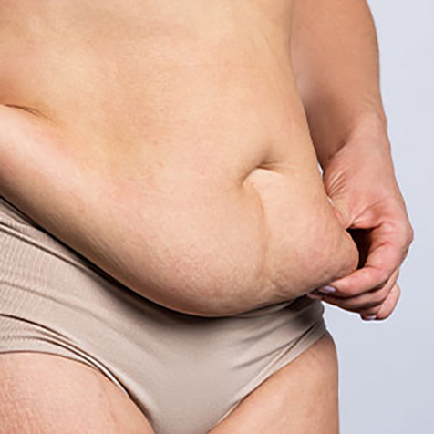 Muffin Top treatment options at True Form Medical Group in Fremont