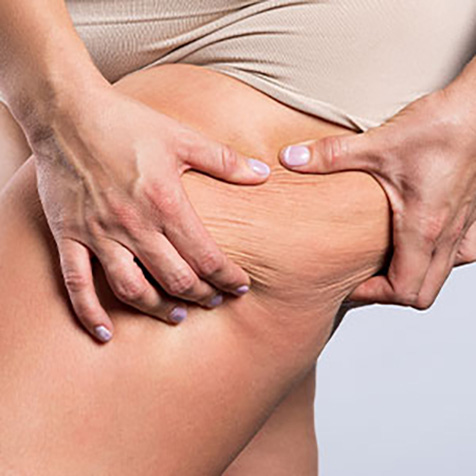 Saddle Bags treatment options at True Form Medical Group in Fremont