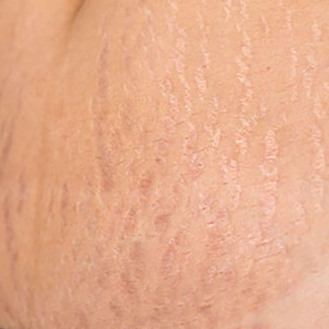 Stretch Marks treatment options at True Form Medical Group in Fremont