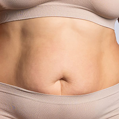 Stubborn Fat treatment options at True Form Medical Group in Fremont