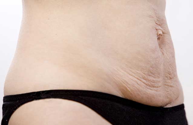 Woman in need of skin tightening treatment in Fremont