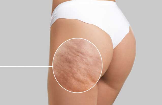 Woman in need of cellulite treatment in Fremont