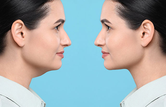 Woman's results from double chin reduction in Fremont