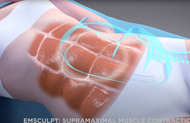 How Emsculpt works at True Form Medical Group in Fremont and Oakland